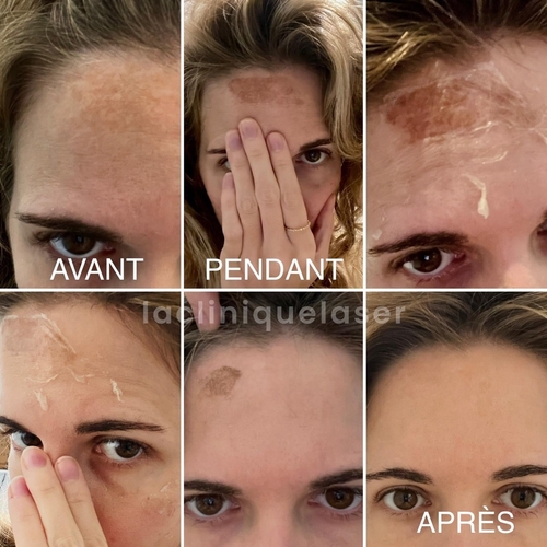 traitement peeling moyen visage acide