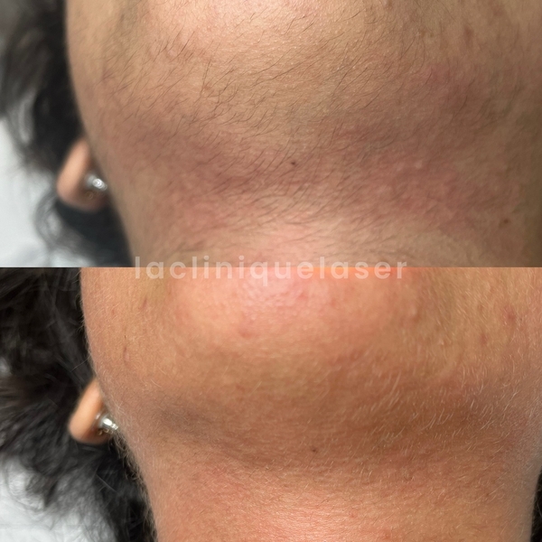 Bleaching visage