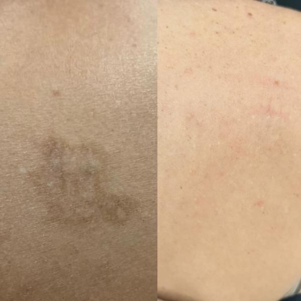 détatouage laser bras marseille