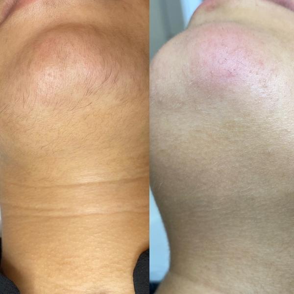 Bleaching visage