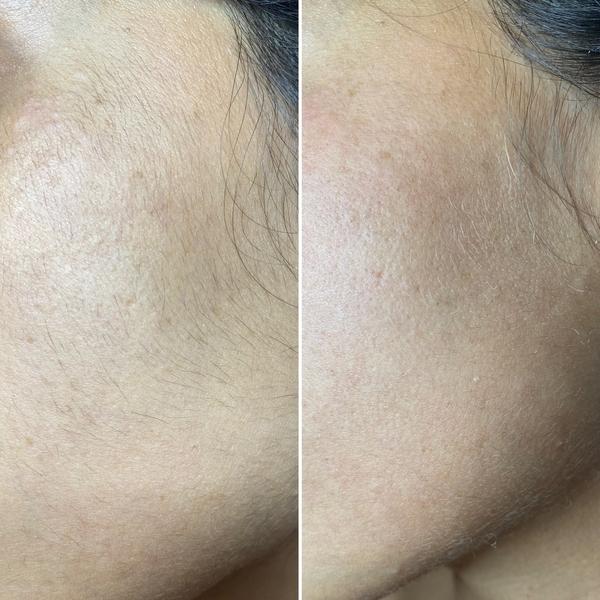 Bleaching visage