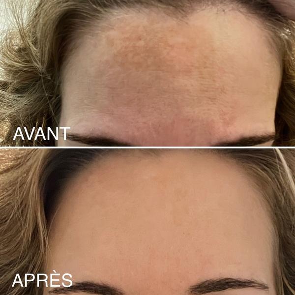 traitement peeling moyen visage acide