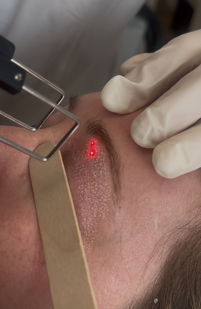 Resurfaçage au laser CO2 Marseille