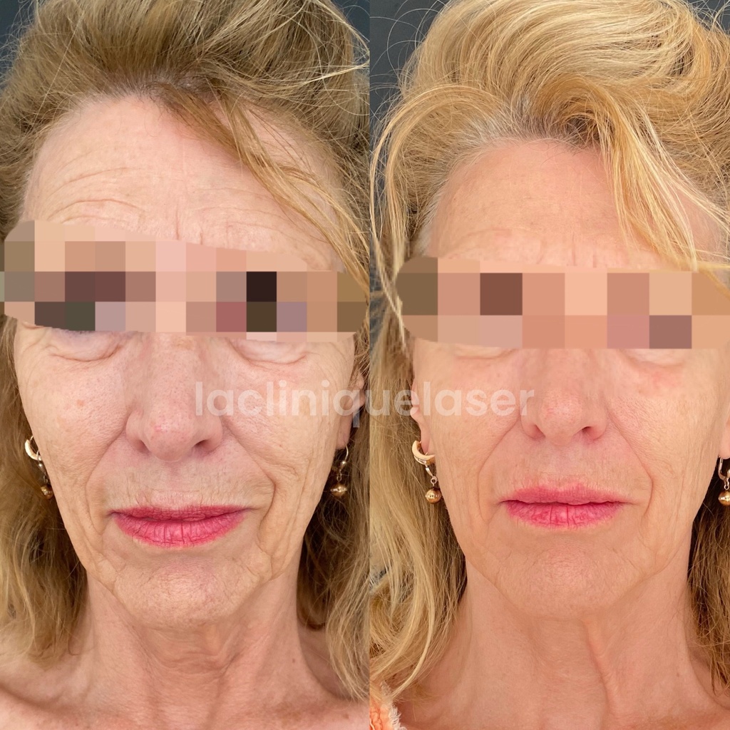 Injections acide hyaluronique résultats naturels