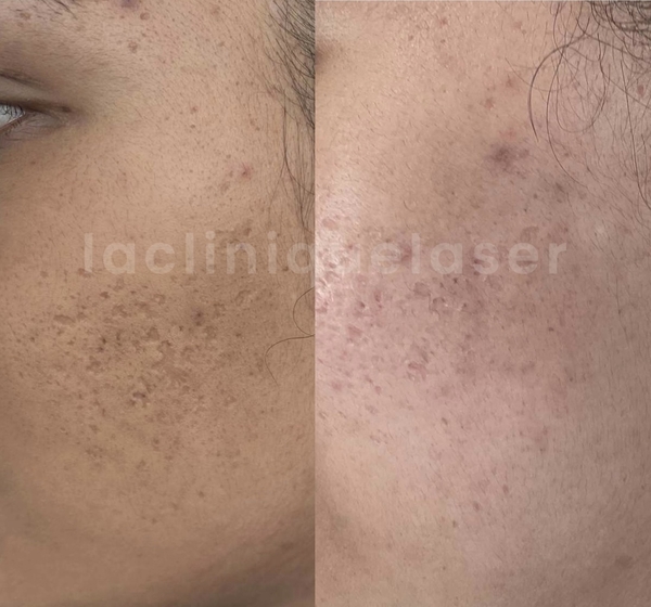 Avant / après sur cicatrices d'acné