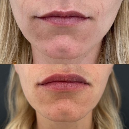 Avant / après injections lèvres