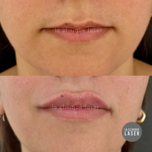 Avant / après injections acide hyaluronique lèvres