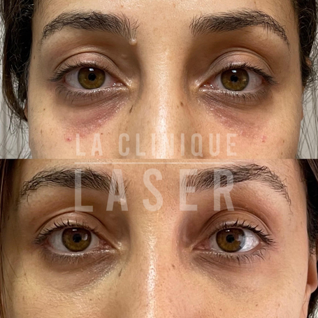 Avant / après injections cernes