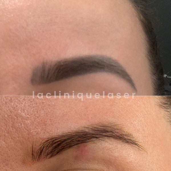 Avant / après détatouage sourcils (shading)