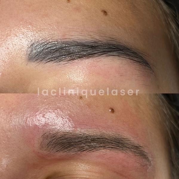 Avant / après détatouage cosmétique sourcils