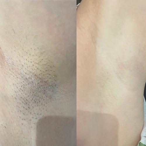 Avant / après épilation laser jambes & aisselles