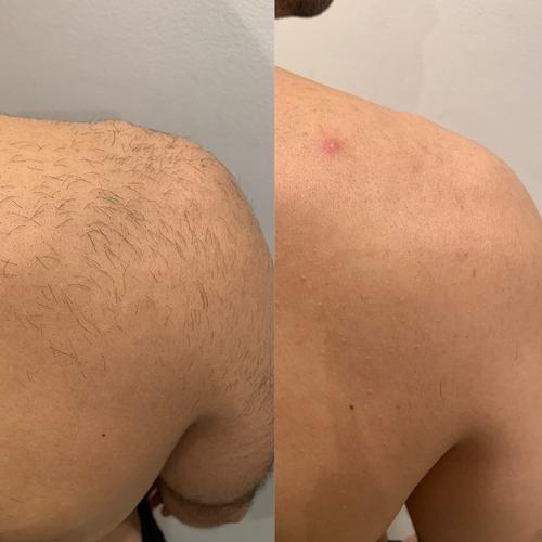 Avant / après épilation laser homme