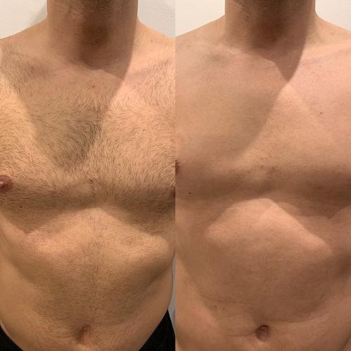 Avant / après épilation laser homme