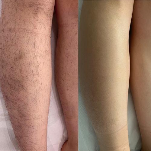 Avant / après épilation laser jambes & aisselles