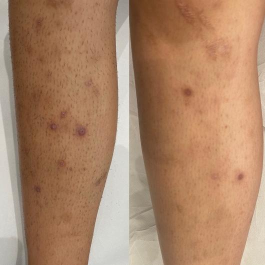 Avant / après traitements des poils incarnés par épilation laser