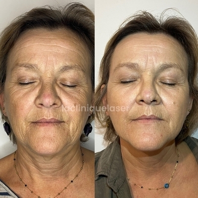 Avant / après injections LANLUMA®