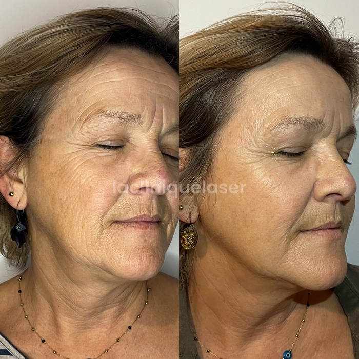 Avant / après injections LANLUMA®