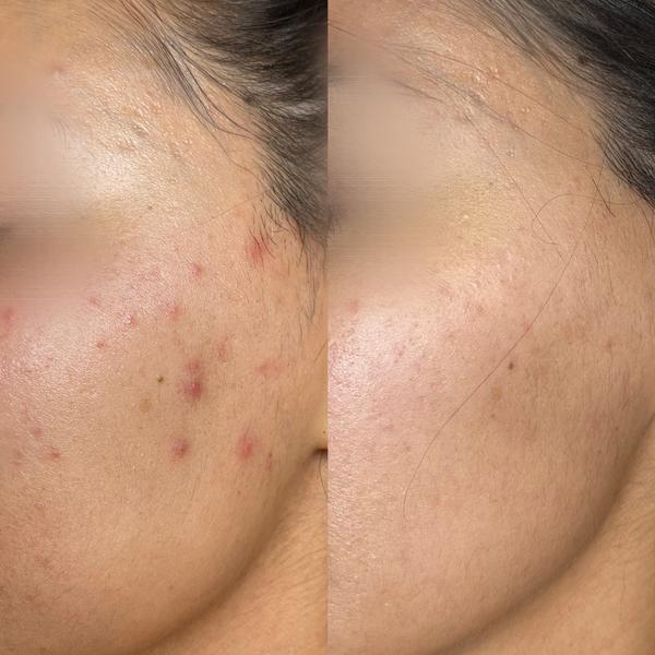 Avant / après sur acné visage