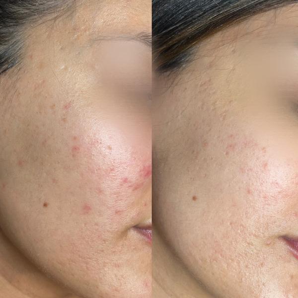 Avant / après sur acné visage