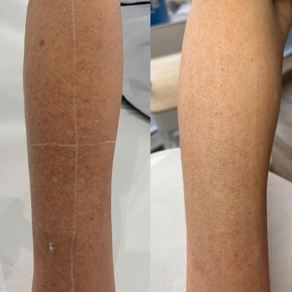 Avant / après héliodermite diffuse