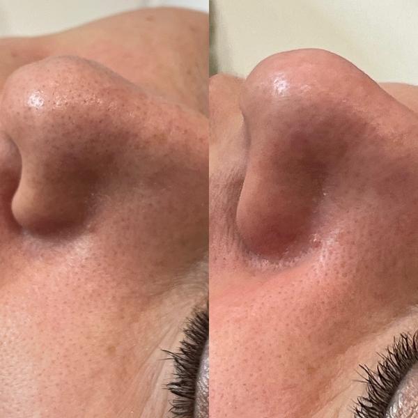 Avant / après Hydroderma