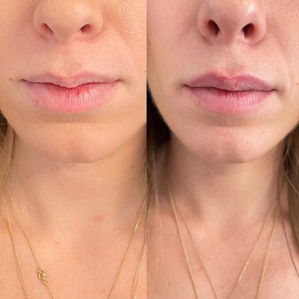 Avant / après injections lèvres