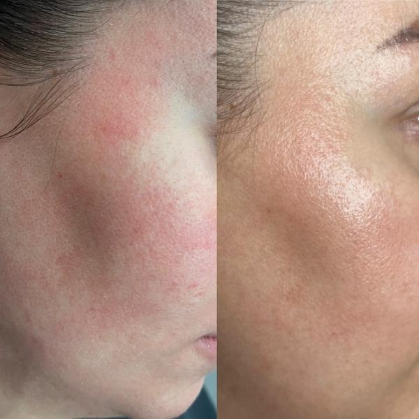 Avant / après laser vasculaire