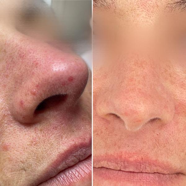 Avant / après laser vasculaire