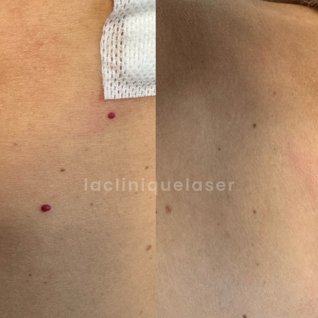Avant / après sur taches rubis