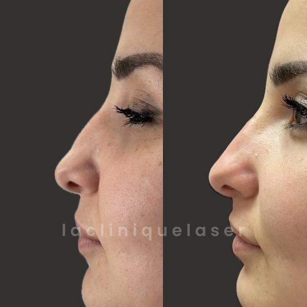Avant / après rhinoplastie médicale