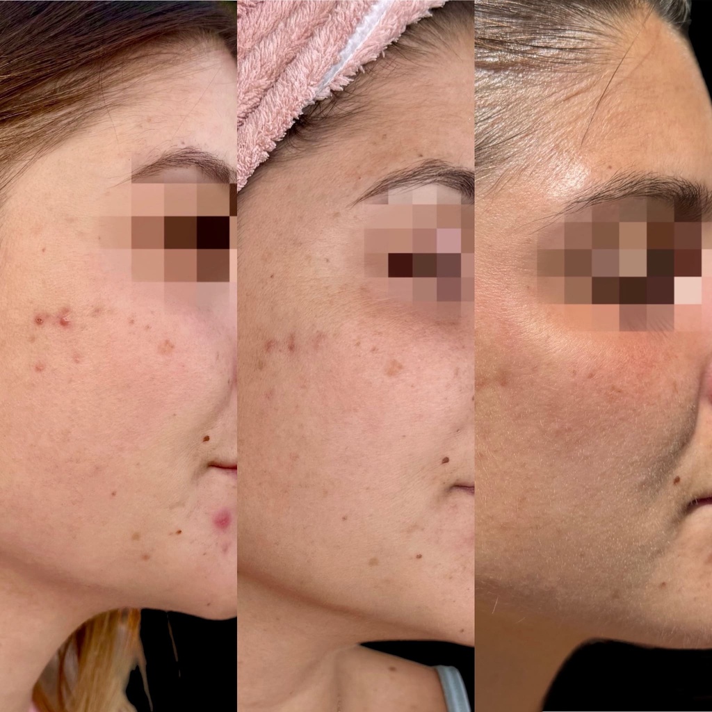 Traitement microneedling La Clinique Laser