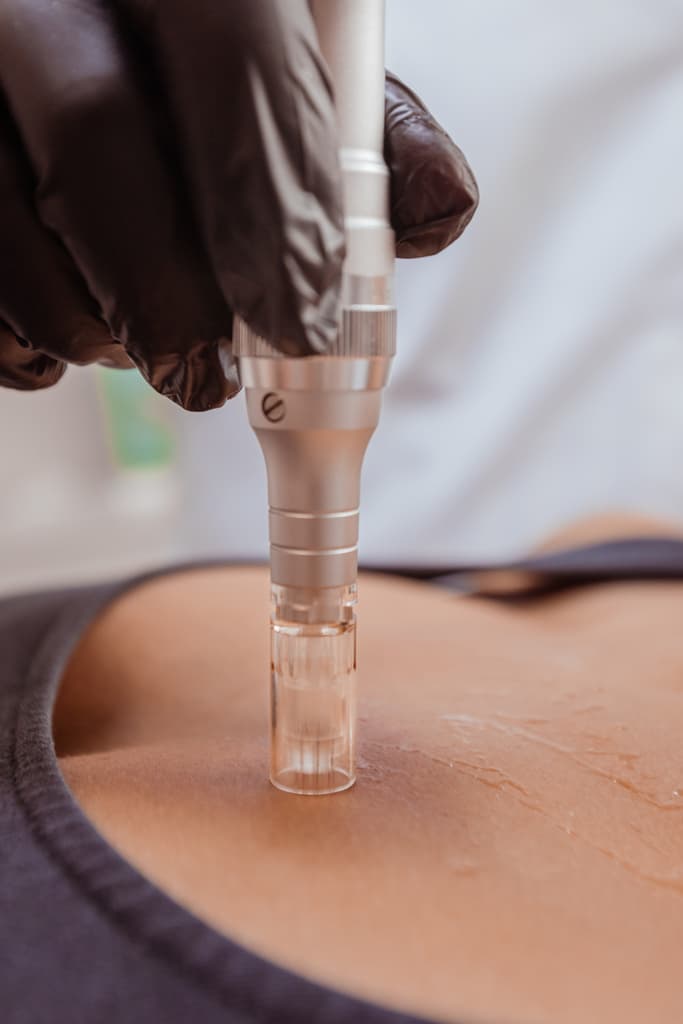 microneedling.jpg