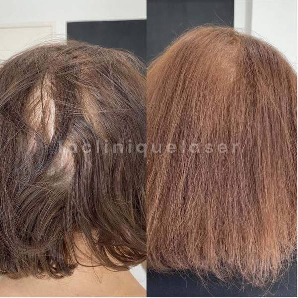 Traitement PRP capillaire cheveux