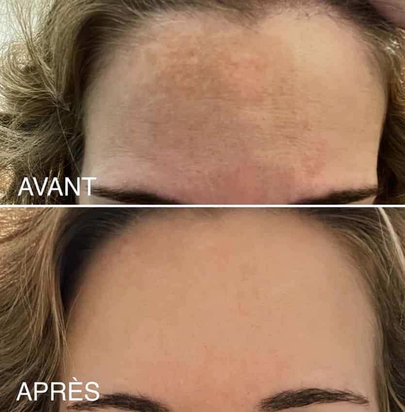 resultats-cliente-peeling.jpg
