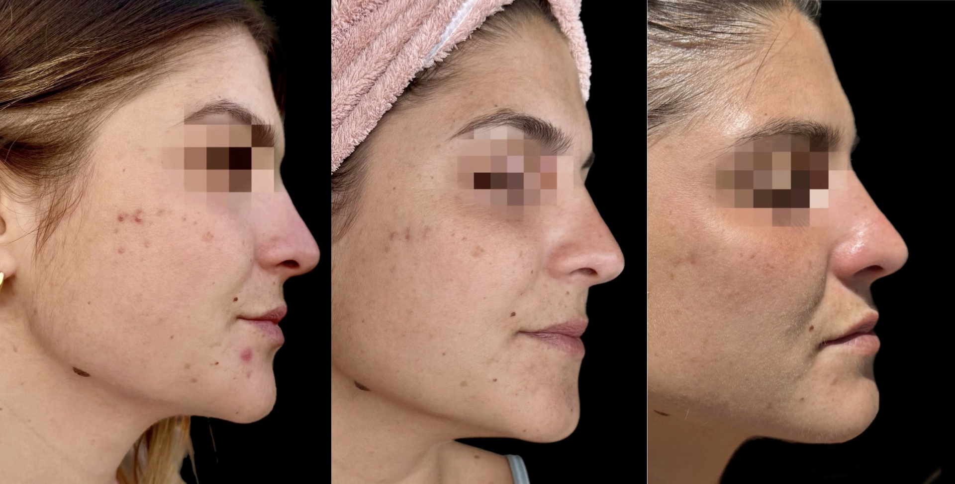 Traitement microneedling marseille