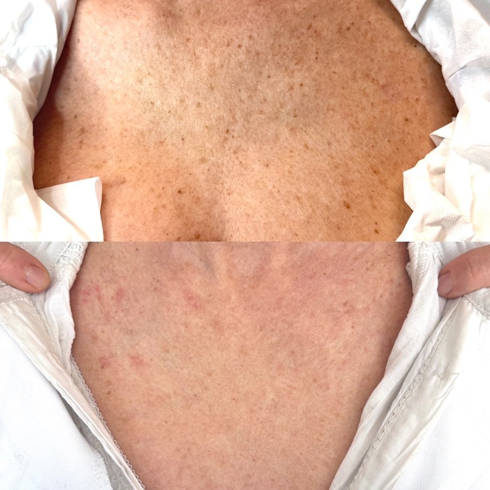 Taches pigmentaires du décolleté avant (en haut) et après (en bas) un traitement par lumière pulsée IPL