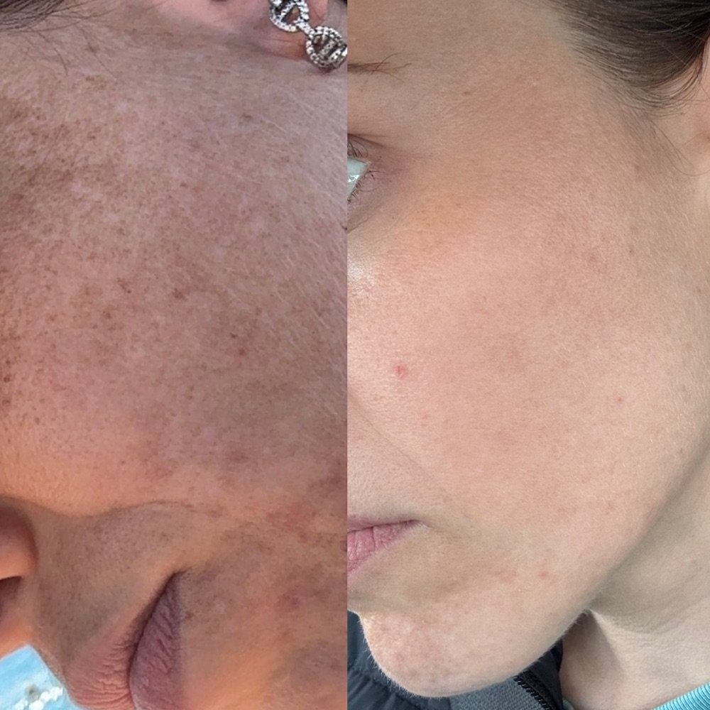 Taches brunes du visage avant (à gauche) et après (à droite) un traitement par lumière pulsée IPL
