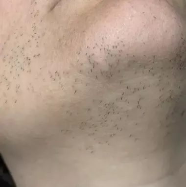 Epilation lumiere pulsée marseille clinique laser