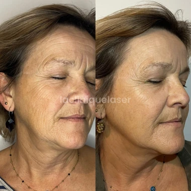 Avant / après injections LANLUMA®