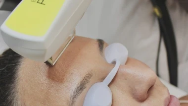 Taches brunes du visage : le traitement par IPL