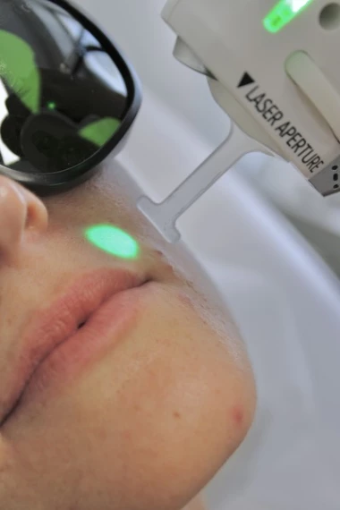 Tout savoir sur l'épilation laser à Marseille et Nice