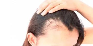 Le PRP contre la chute des cheveux à la ménopause