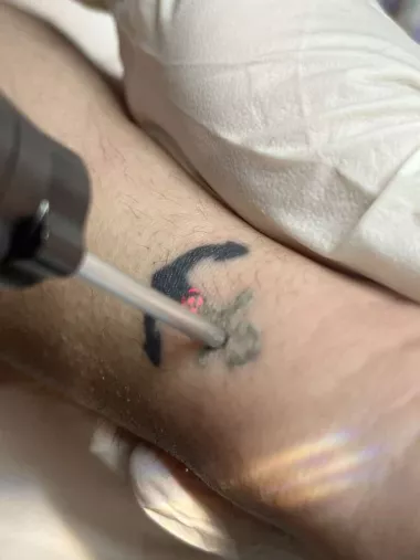 Le laser efficace pour enlever un tatouage
