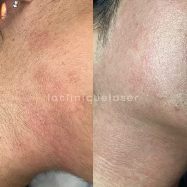 Bleaching visage