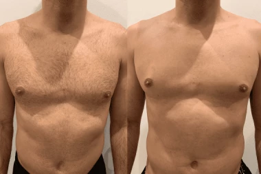 Épilation laser homme Nice & Marseille | Résultats visibles