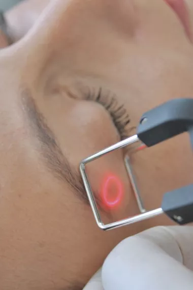 Corriger les rides du contour des yeux | Laser CO2 fractionné
