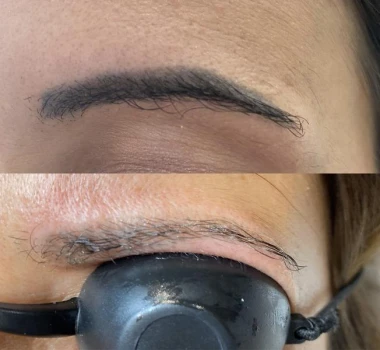 Avant / après détatouage cosmétique sourcils
