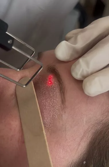 Resurfaçage au laser CO2 Marseille