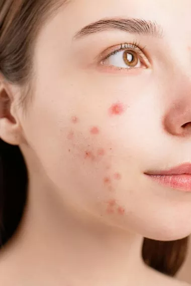 Traitement peeling acné visage Nice
