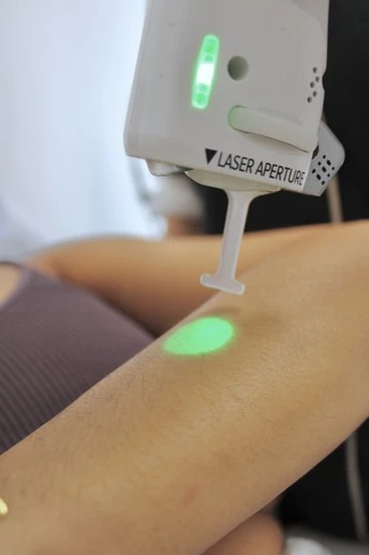 Épilation laser : avant, pendant et après vos séances